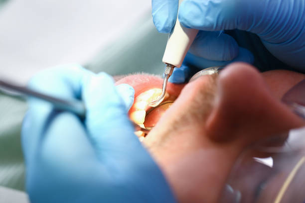 Best Emergency Dental Care for Broken or Chipped Teeth in Hauser, ID